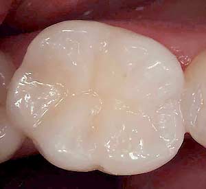 Corinthia Dental Clinic | Leduc Dentist | White Fillings
